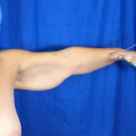 Arm Lift Before & After Patient #7196