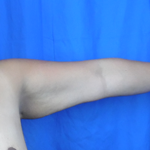 Arm Lift Before & After Patient #7209