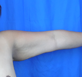 Arm Lift Before & After Patient #7209