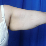 Arm Lift Before & After Patient #7214