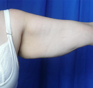 Arm Lift Before & After Patient #7214