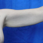 Arm Lift Before & After Patient #7217