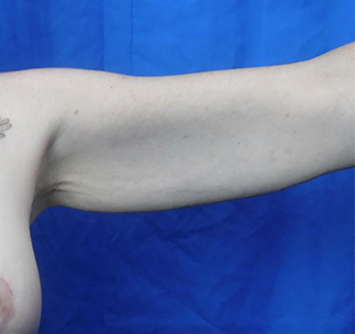 Arm Lift Before & After Patient #7217