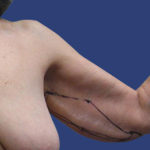 Arm Lift Before & After Patient #7222