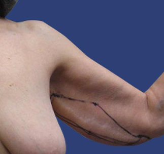 Arm Lift Before & After Patient #7222