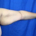 Arm Lift Before & After Patient #7225