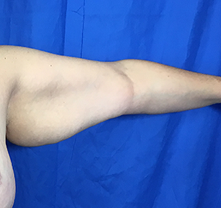 Arm Lift Before & After Patient #7225