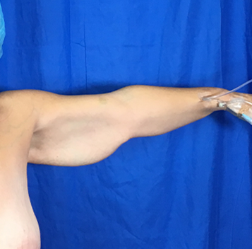 Arm Lift Before & After Patient #7196