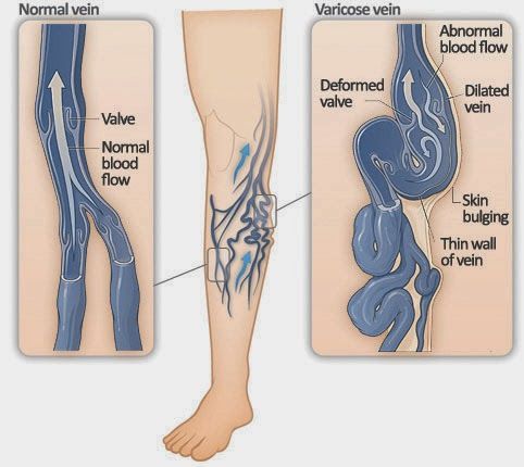 Varicose Vein Removal Beverly Hills and Los Angeles