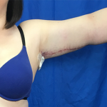 Arm Lift Before & After Patient #7206