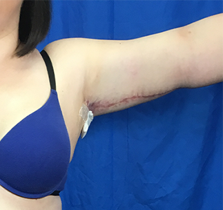 Arm Lift Before & After Patient #7206