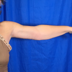 Arm Lift Before & After Patient #7196