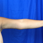 Arm Lift Before & After Patient #7209