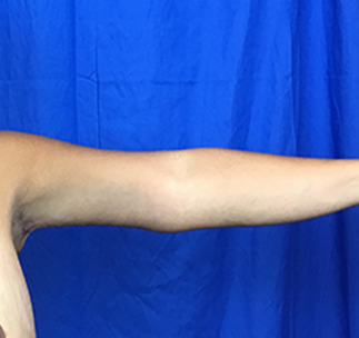 Arm Lift Before & After Patient #7209