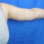 Arm Lift Before & After Patient #7214
