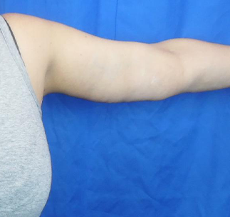 Arm Lift Before & After Patient #7214