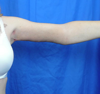 Arm Lift Before & After Patient #7217