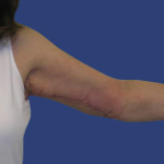 Arm Lift Before & After Patient #7222