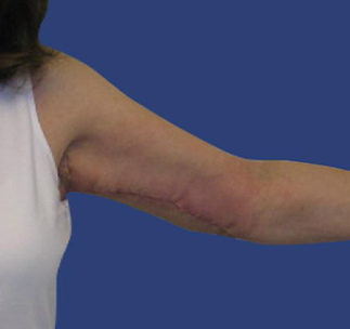 Arm Lift Before & After Patient #7222