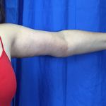 Arm Lift Before & After Patient #7225