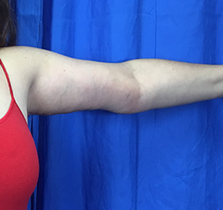 Arm Lift Before & After Patient #7225