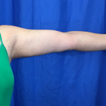 Arm Lift Before & After Patient #7191