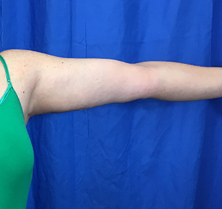 Arm Lift Before & After Patient #7191