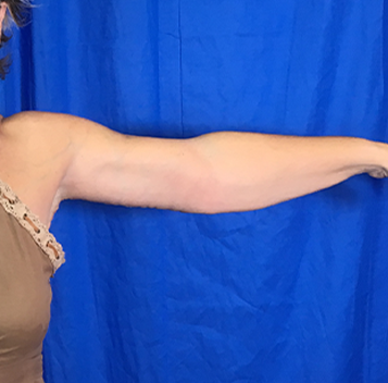 Arm Lift Before & After Patient #7196