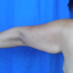 Arm Lift Before & After Patient #7209