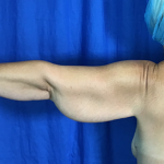 Arm Lift Before & After Patient #7196