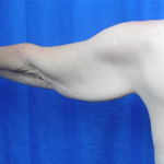 Arm Lift Before & After Patient #7217