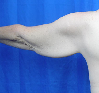 Arm Lift Before & After Patient #7217