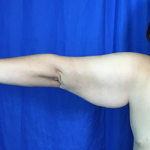 Arm Lift Before & After Patient #7225