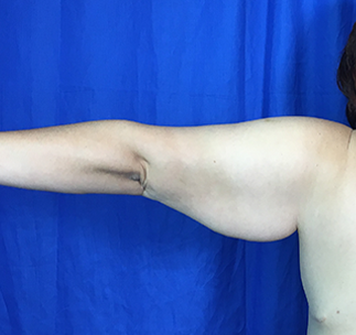 Arm Lift Before & After Patient #7225