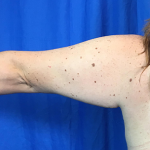 Arm Lift Before & After Patient #7191