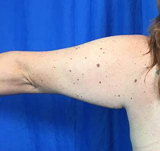 Arm Lift Before & After Patient #7191