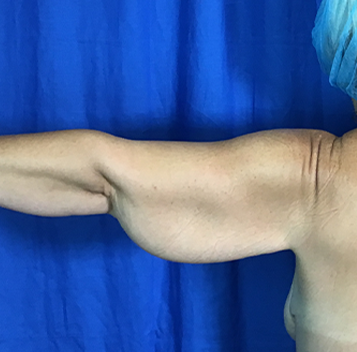 Arm Lift Before & After Patient #7196