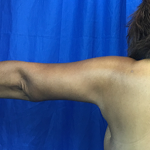 Arm Lift Before & After Patient #7209