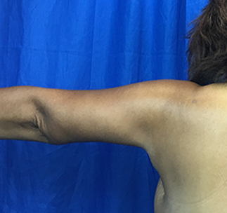 Arm Lift Before & After Patient #7209