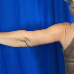 Arm Lift Before & After Patient #7196