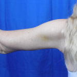 Arm Lift Before & After Patient #7217