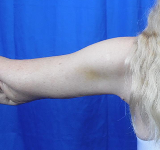 Arm Lift Before & After Patient #7217