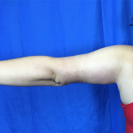 Arm Lift Before & After Patient #7225