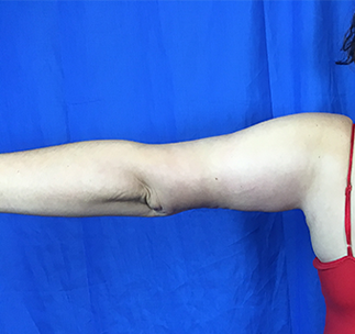Arm Lift Before & After Patient #7225