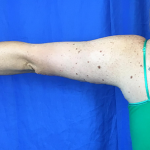 Arm Lift Before & After Patient #7191