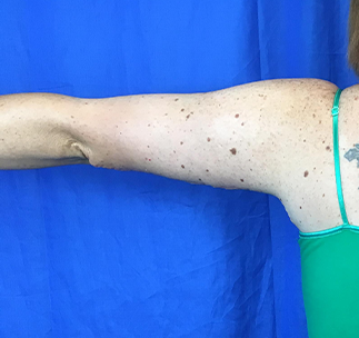 Arm Lift Before & After Patient #7191