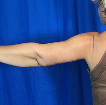 Arm Lift Before & After Patient #7196