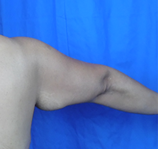 Arm Lift Before & After Patient #7209