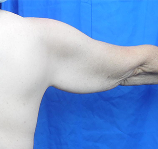 Arm Lift Before & After Patient #7217