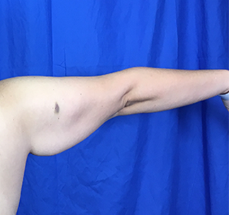 Arm Lift Before & After Patient #7225